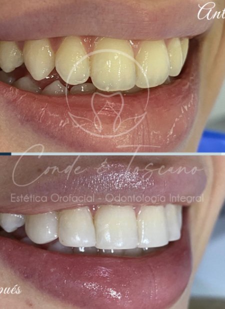 Microdiseño de sonrisa